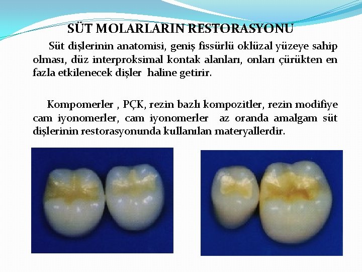 SÜT MOLARLARIN RESTORASYONU Süt dişlerinin anatomisi, geniş fissürlü oklüzal yüzeye sahip olması, düz interproksimal