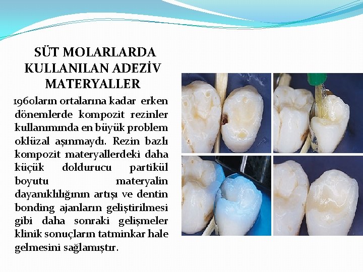 SÜT MOLARLARDA KULLANILAN ADEZİV MATERYALLER 1960 ların ortalarına kadar erken dönemlerde kompozit rezinler kullanımında