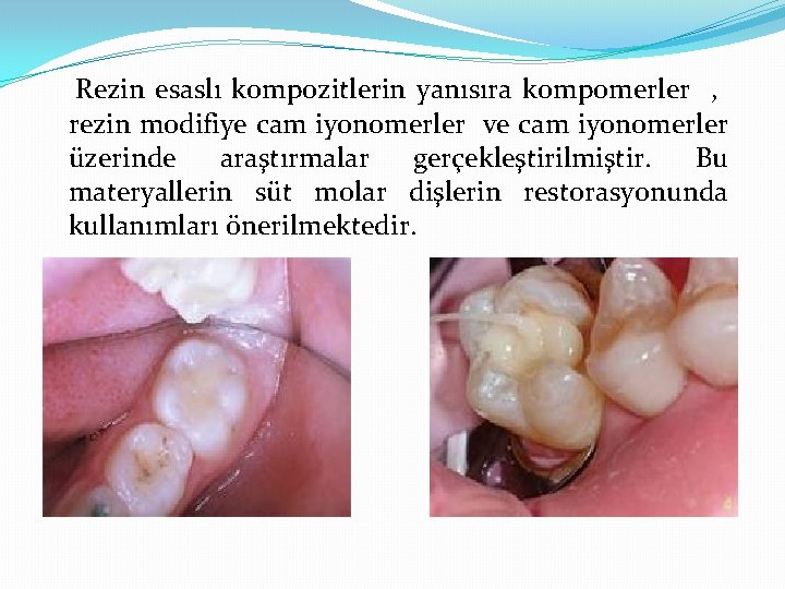 Rezin esaslı kompozitlerin yanısıra kompomerler , rezin modifiye cam iyonomerler ve cam iyonomerler üzerinde