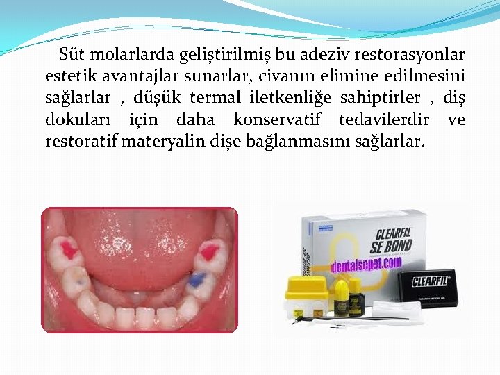 Süt molarlarda geliştirilmiş bu adeziv restorasyonlar estetik avantajlar sunarlar, civanın elimine edilmesini sağlarlar ,