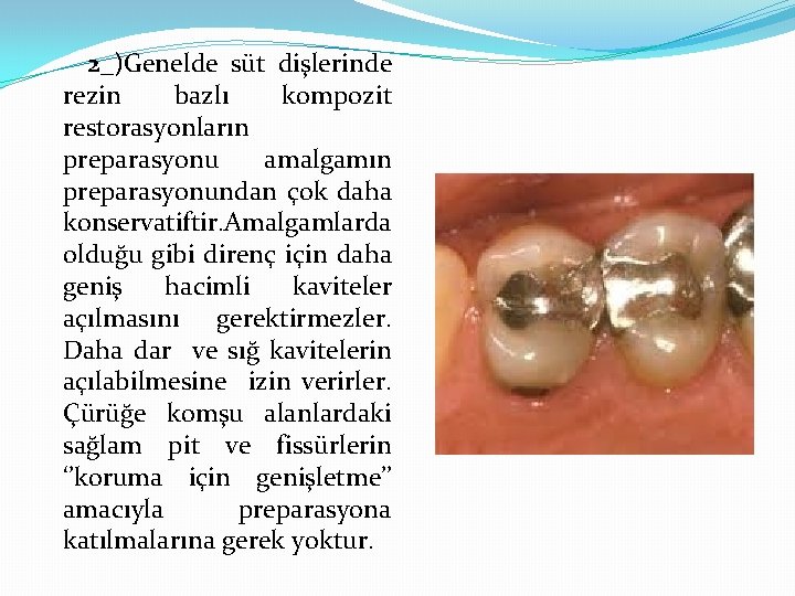 2_)Genelde süt dişlerinde rezin bazlı kompozit restorasyonların preparasyonu amalgamın preparasyonundan çok daha konservatiftir. Amalgamlarda