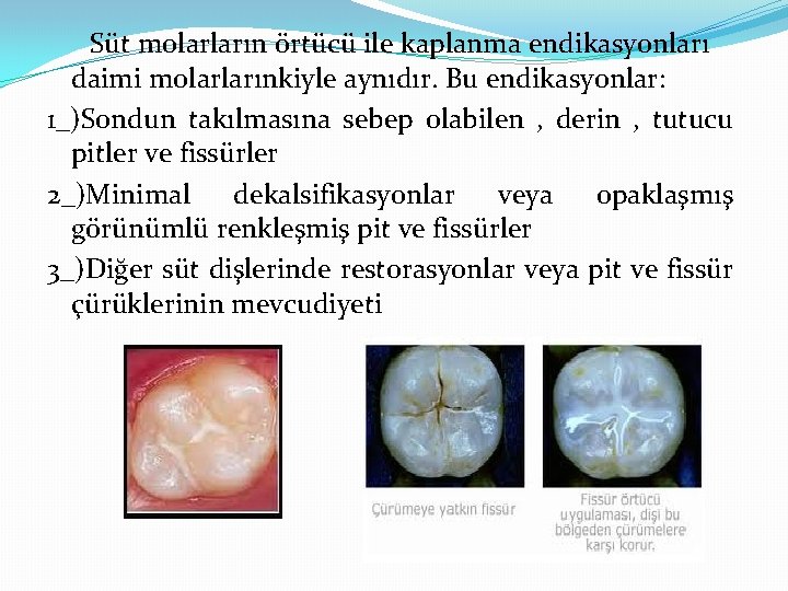 Süt molarların örtücü ile kaplanma endikasyonları daimi molarlarınkiyle aynıdır. Bu endikasyonlar: 1_)Sondun takılmasına sebep