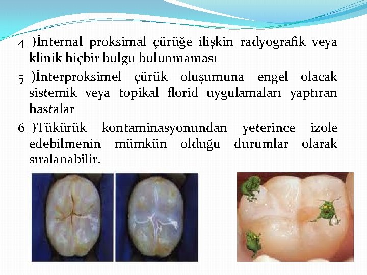 4_)İnternal proksimal çürüğe ilişkin radyografik veya klinik hiçbir bulgu bulunmaması 5_)İnterproksimel çürük oluşumuna engel