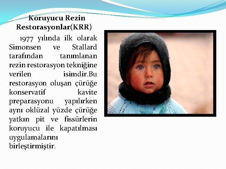 Koruyucu Rezin Restorasyonlar(KRR) 1977 yılında ilk olarak Simonsen ve Stallard tarafından tanımlanan rezin restorasyon