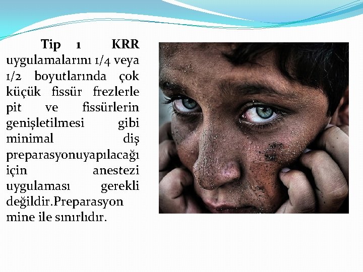 Tip 1 KRR uygulamalarını 1/4 veya 1/2 boyutlarında çok küçük fissür frezlerle pit ve