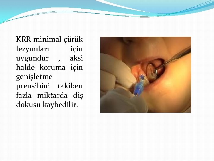 KRR minimal çürük lezyonları için uygundur , aksi halde koruma için genişletme prensibini takiben