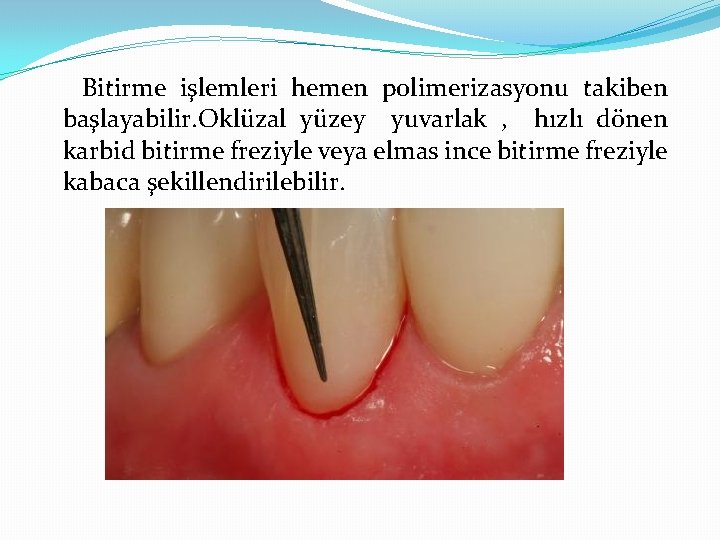 Bitirme işlemleri hemen polimerizasyonu takiben başlayabilir. Oklüzal yüzey yuvarlak , hızlı dönen karbid bitirme