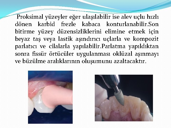 Proksimal yüzeyler eğer ulaşılabilir ise alev uçlu hızlı dönen karbid frezle kabaca konturlanabilir. Son