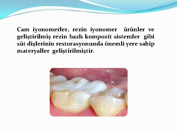 Cam iyonomerler, rezin iyonomer ürünler ve geliştirilmiş rezin bazlı kompozit sistemler gibi süt dişlerinin