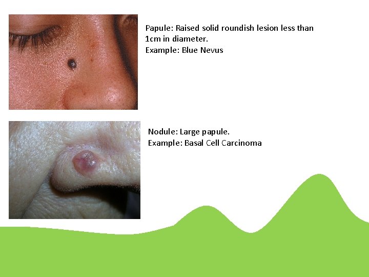 Papule: Raised solid roundish lesion less than 1 cm in diameter. Example: Blue Nevus