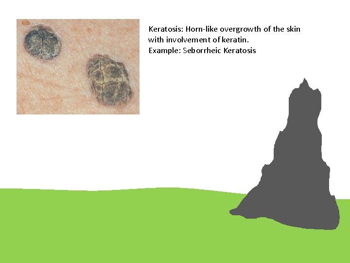 Keratosis: Horn-like overgrowth of the skin with involvement of keratin. Example: Seborrheic Keratosis 