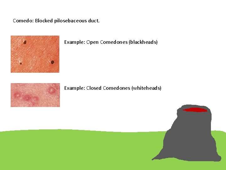 Comedo: Blocked pilosebaceous duct. Example: Open Comedones (blackheads) Example: Closed Comedones (whiteheads) 