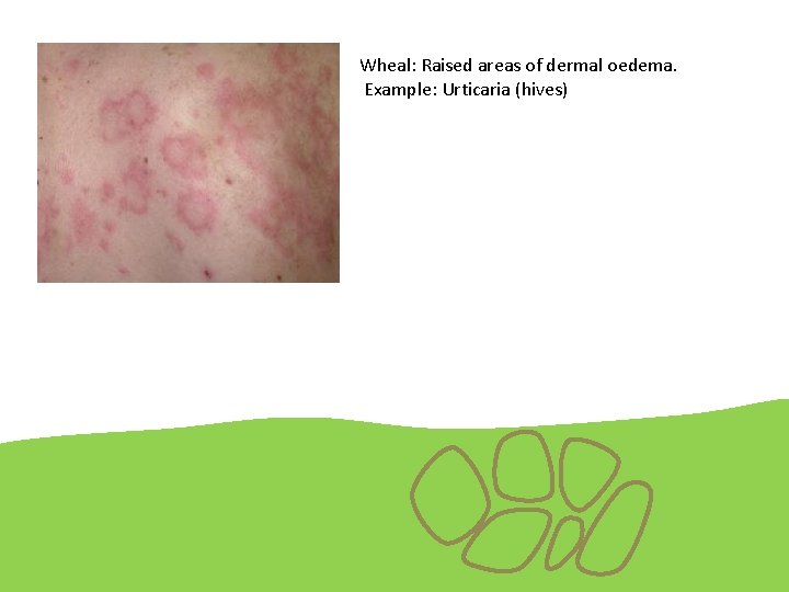 Wheal: Raised areas of dermal oedema. Example: Urticaria (hives) 