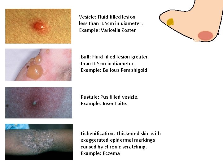 Vesicle: Fluid filled lesion less than 0. 5 cm in diameter. Example: Varicella Zoster