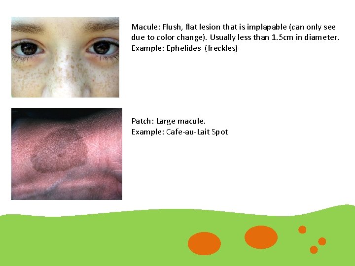 Macule: Flush, flat lesion that is implapable (can only see due to color change).