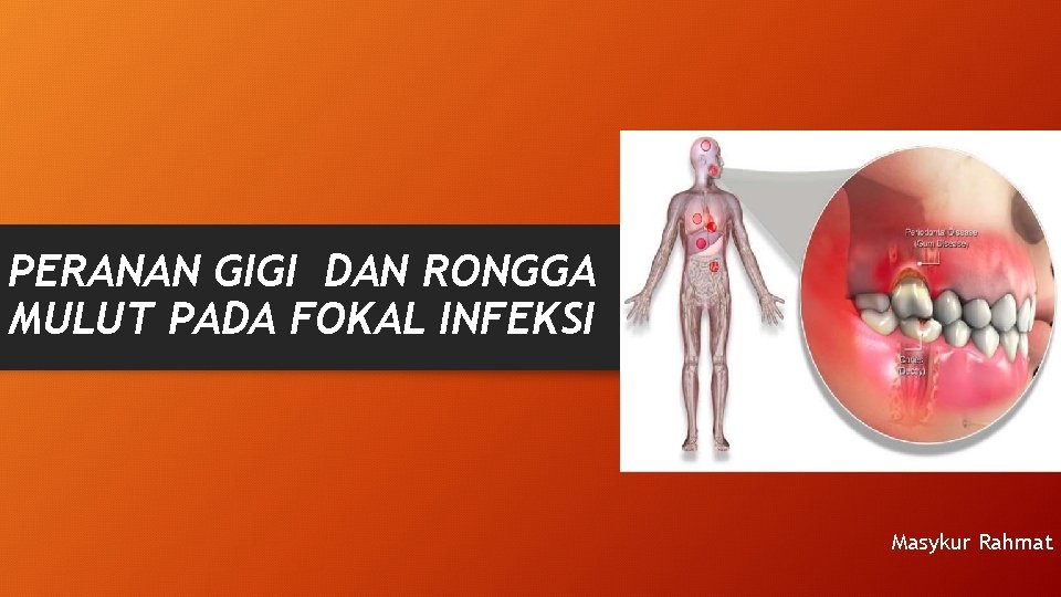 PERANAN GIGI DAN RONGGA MULUT PADA FOKAL INFEKSI Masykur Rahmat PERANAN GIGI DAN RONGGA MULUT PADA FOKAL INFEKSI Masykur Rahmat