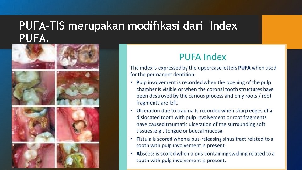 PUFA-TIS merupakan modifikasi dari Index PUFA. PUFA-TIS merupakan modifikasi dari Index PUFA.