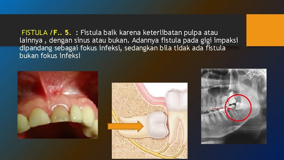 FISTULA /F. . 5. : Fistula baik karena keterlibatan pulpa atau lainnya , dengan FISTULA /F. . 5. : Fistula baik karena keterlibatan pulpa atau lainnya , dengan