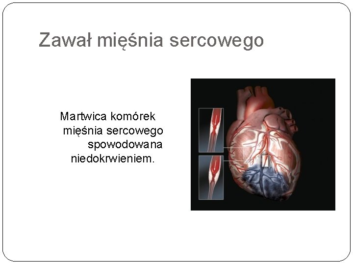 Zawał mięśnia sercowego Martwica komórek mięśnia sercowego spowodowana niedokrwieniem. 