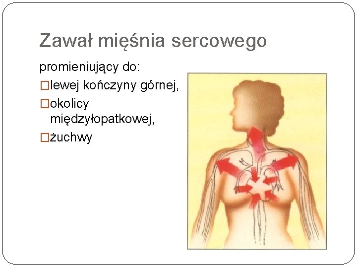 Zawał mięśnia sercowego promieniujący do: �lewej kończyny górnej, �okolicy międzyłopatkowej, �żuchwy 