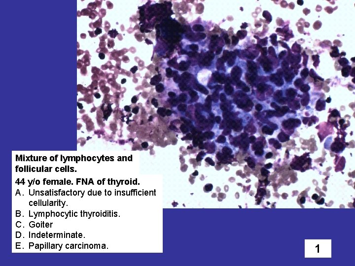 Mixture of lymphocytes and follicular cells. 44 y/o female. FNA of thyroid. A. Unsatisfactory