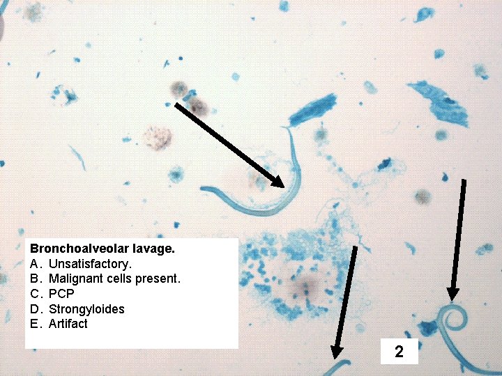 Bronchoalveolar lavage. A. Unsatisfactory. B. Malignant cells present. C. PCP D. Strongyloides E. Artifact