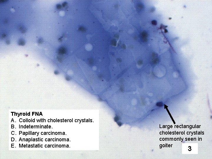 Thyroid FNA A. Colloid with cholesterol crystals. B. Indeterminate. C. Papillary carcinoma. D. Anaplastic