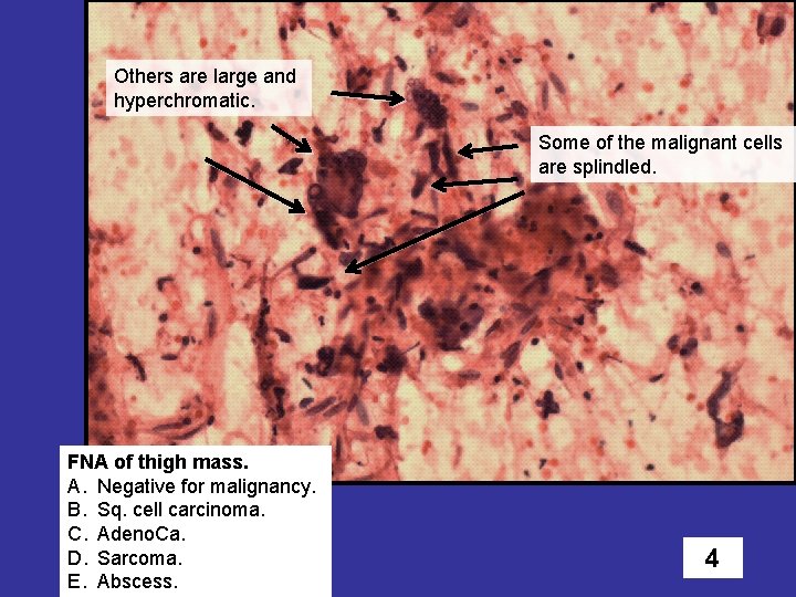 Others are large and hyperchromatic. Some of the malignant cells are splindled. FNA of