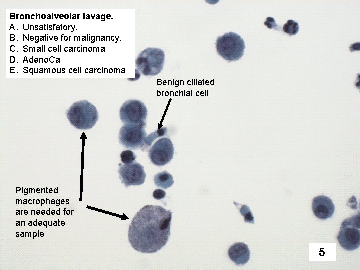 Bronchoalveolar lavage. A. Unsatisfatory. B. Negative for malignancy. C. Small cell carcinoma D. Adeno.