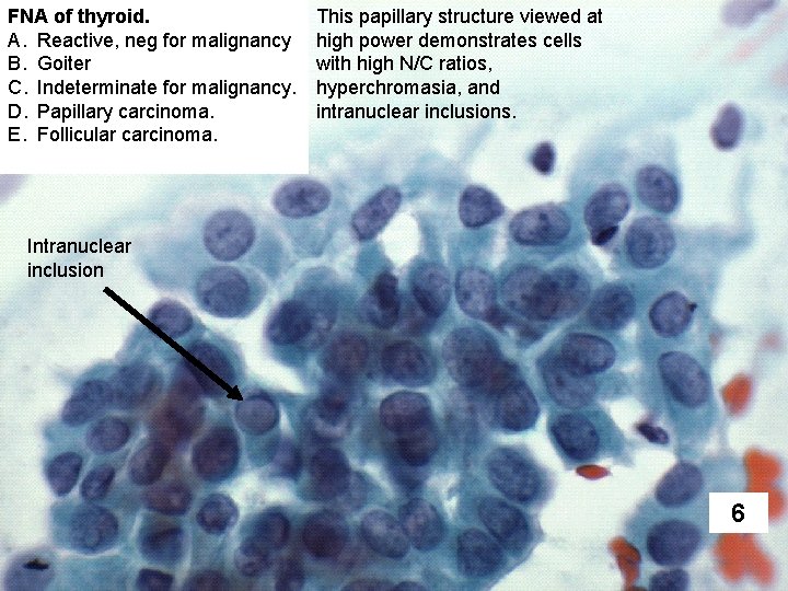 FNA of thyroid. A. Reactive, neg for malignancy B. Goiter C. Indeterminate for malignancy.