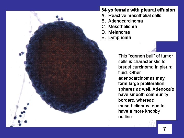 54 yo female with pleural effusion A. Reactive mesothelial cells B. Adenocarcinoma C. Mesothelioma