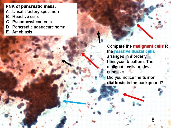 FNA of pancreatic mass. A. Unsatisfactory specimen B. Reactive cells C. Pseudocyst contents D.