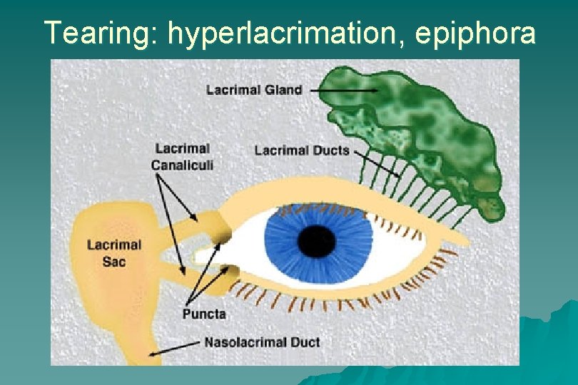 Tearing: hyperlacrimation, epiphora 