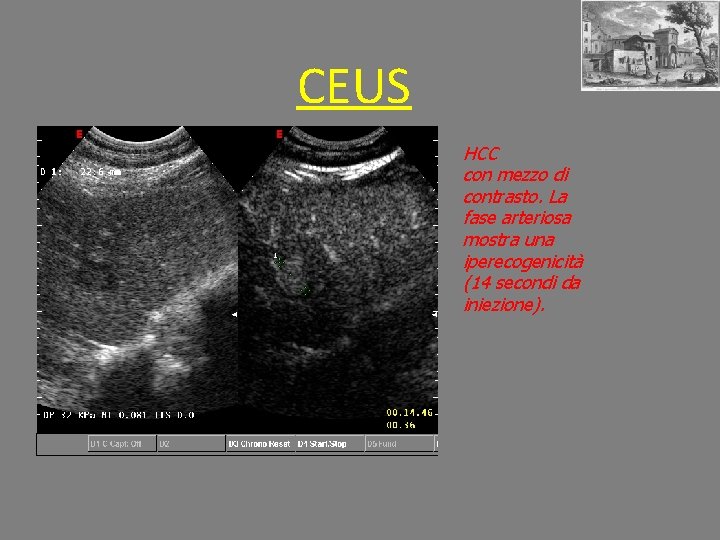 CEUS HCC con mezzo di contrasto. La fase arteriosa mostra una iperecogenicità (14 secondi