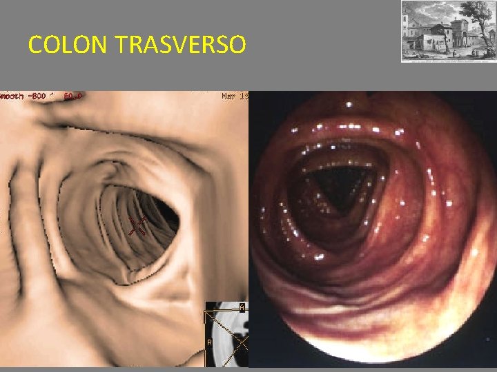 COLON TRASVERSO 