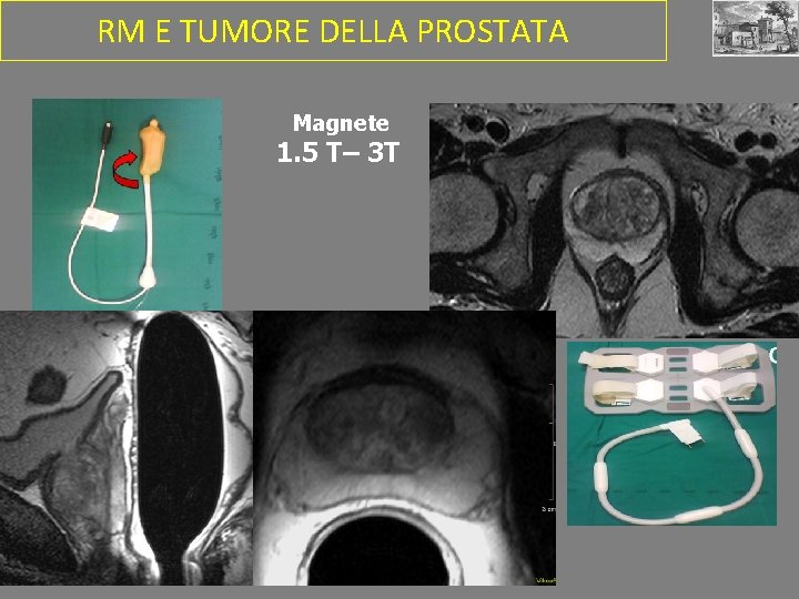 RM E TUMORE DELLA PROSTATA Magnete 1. 5 T– 3 T 