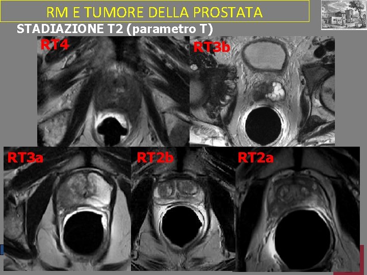 RM E TUMORE DELLA PROSTATA STADIAZIONE T 2 (parametro T) RT 4 RT 3