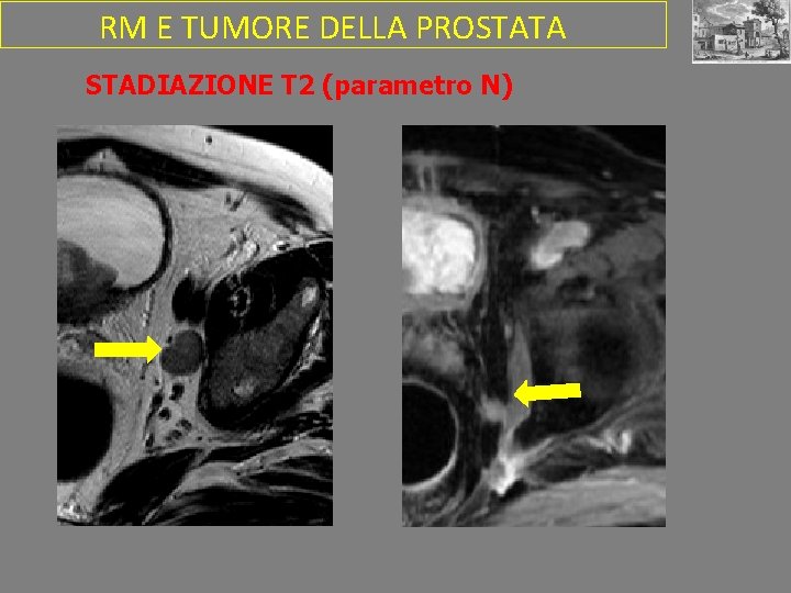 RM E TUMORE DELLA PROSTATA STADIAZIONE T 2 (parametro N) 