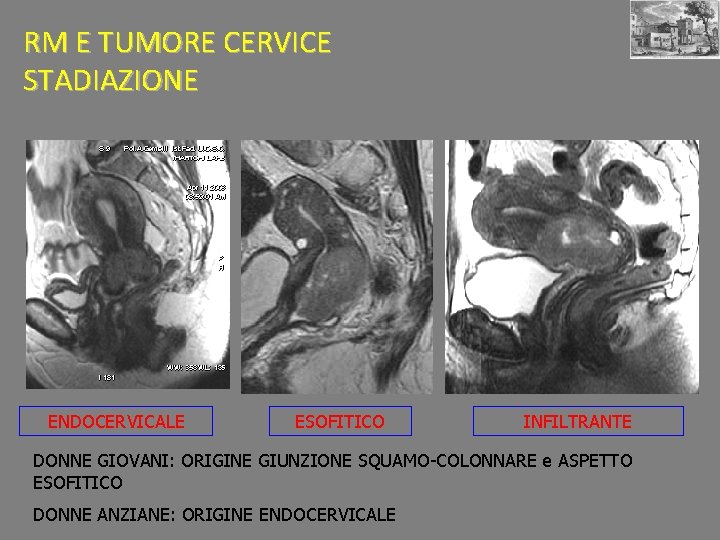 RM E TUMORE CERVICE STADIAZIONE ENDOCERVICALE ESOFITICO INFILTRANTE DONNE GIOVANI: ORIGINE GIUNZIONE SQUAMO-COLONNARE e