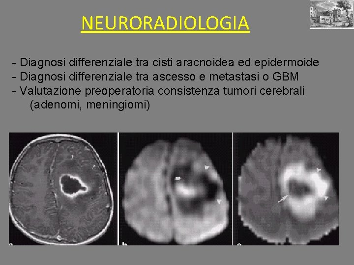 NEURORADIOLOGIA - Diagnosi differenziale tra cisti aracnoidea ed epidermoide - Diagnosi differenziale tra ascesso