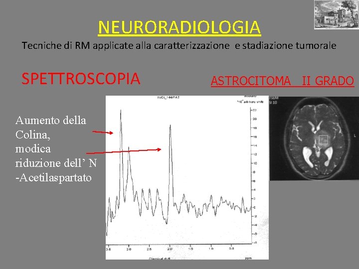 NEURORADIOLOGIA Tecniche di RM applicate alla caratterizzazione e stadiazione tumorale SPETTROSCOPIA Aumento della Colina,