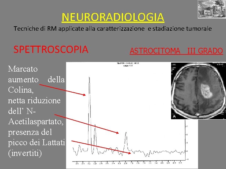 NEURORADIOLOGIA Tecniche di RM applicate alla caratterizzazione e stadiazione tumorale SPETTROSCOPIA Marcato aumento della