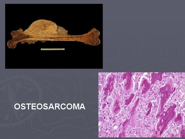 OSTEOSARCOMA 