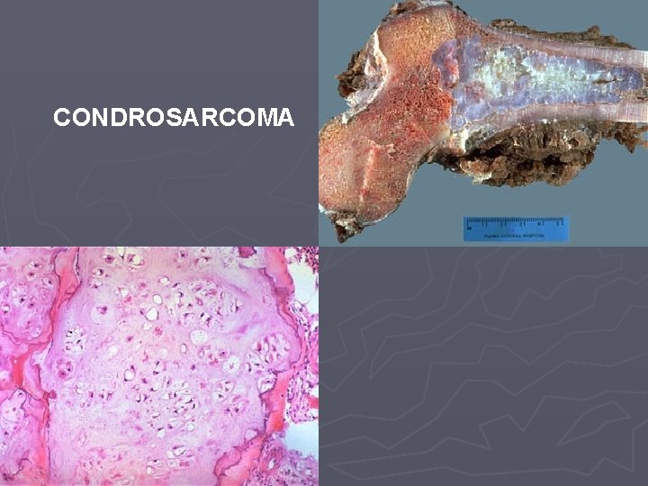 CONDROSARCOMA 