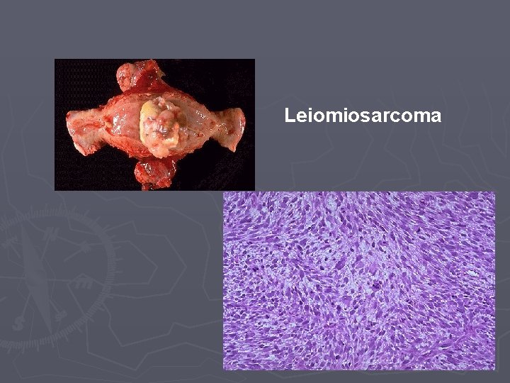 Leiomiosarcoma 