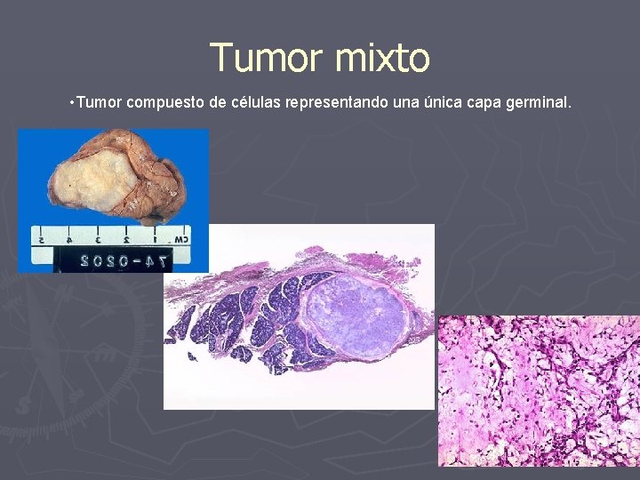 Tumor mixto • Tumor compuesto de células representando una única capa germinal. 