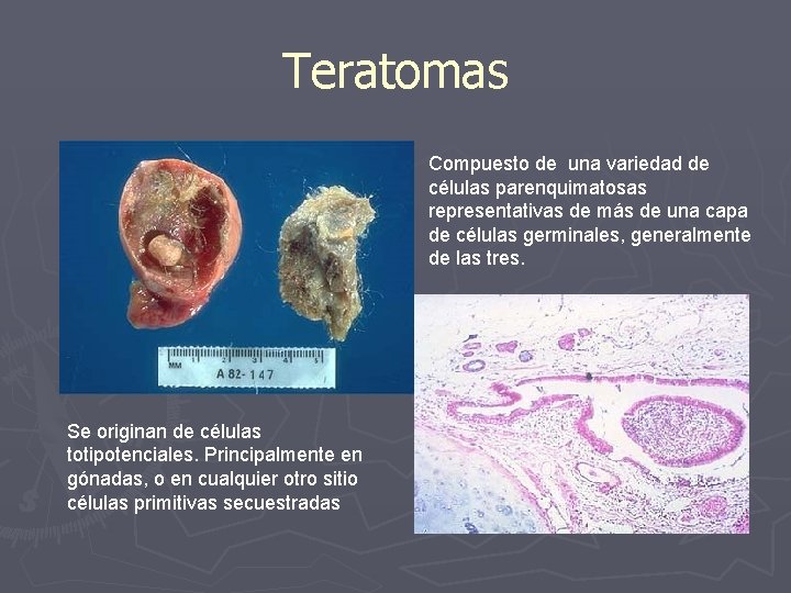 Teratomas Compuesto de una variedad de células parenquimatosas representativas de más de una capa