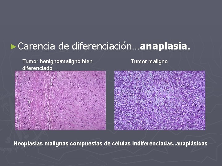 ► Carencia de diferenciación…anaplasia. Tumor benigno/maligno bien diferenciado Tumor maligno Neoplasias malignas compuestas de