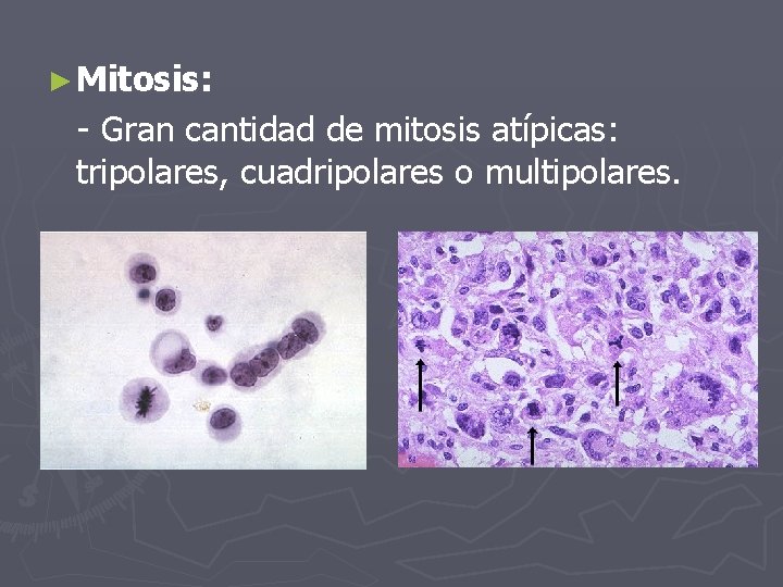 ► Mitosis: - Gran cantidad de mitosis atípicas: tripolares, cuadripolares o multipolares. 
