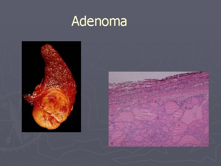 Adenoma 